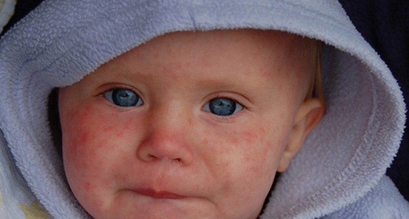 Внимание! Корь!